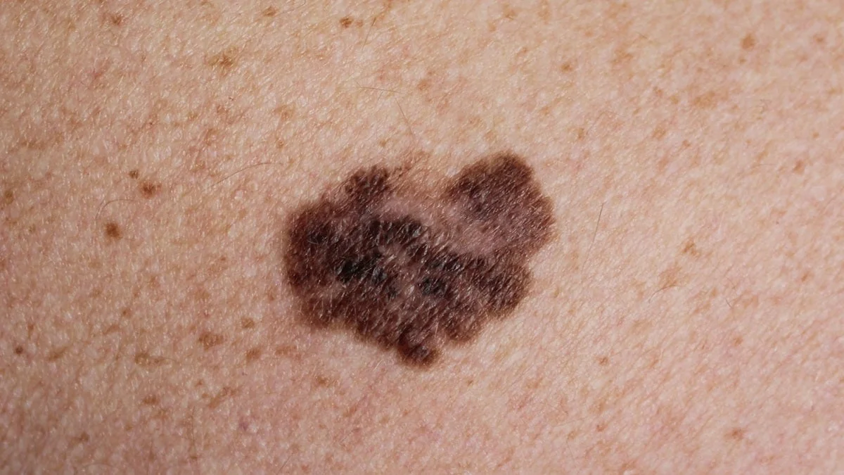Melanoma is seen in this image from the Centers for Disease Control and Prevention. Melanoma is the most deadly form of skin cancer